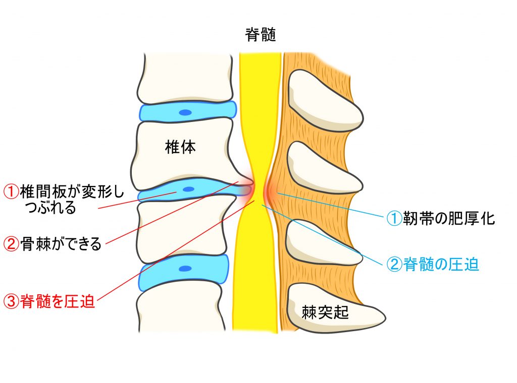 脊髄症型