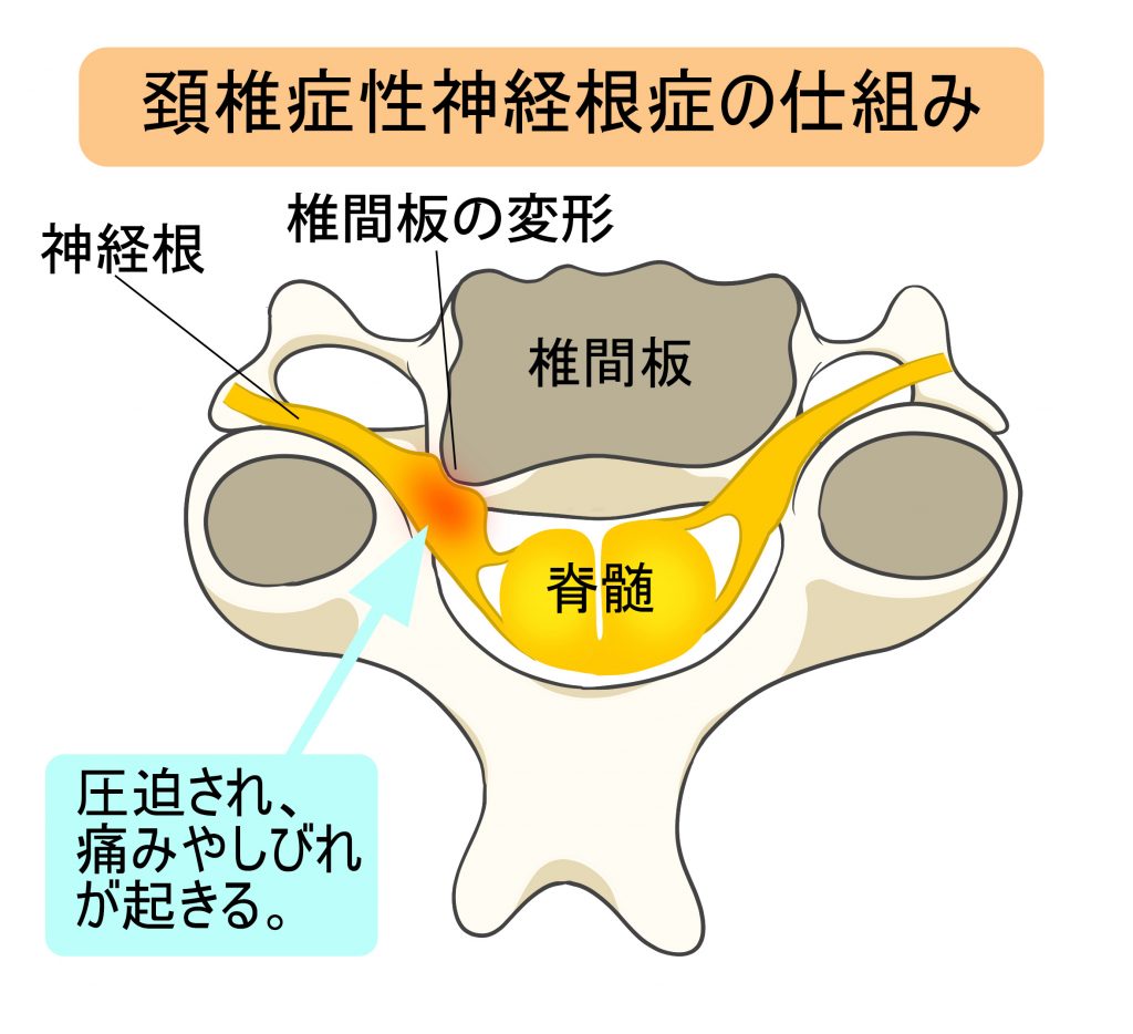 むちうちとは 定義や原因 具体的な症状 治療法 期間までを詳しく解説 大分の交通事故弁護士