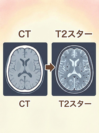 CTとT2スターの比較画像