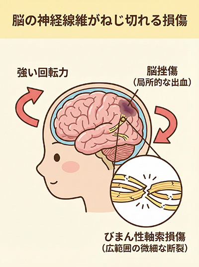 脳の神経線維がねじ切れる損傷（びまん性軸索損傷）
