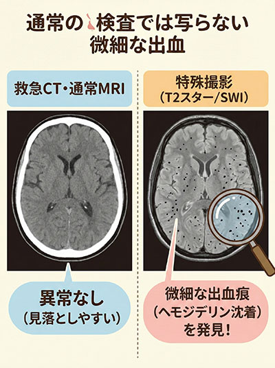 通常の検査では写らない微細な出血（CT・通常MRI vs T2スター/SWI）