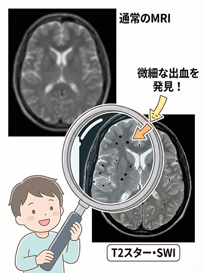 通常MRIとT2スター・SWIの比較（微細な出血を発見）