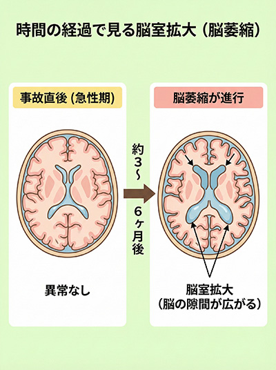 時間の経過で見る脳室拡大（脳萎縮）